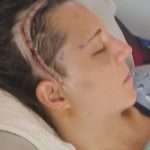 A woman lies in bed with her eyes closed, showing a stitched surgical scar along her scalp, indicating recent head surgery.