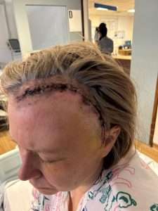 A woman with blonde hair has a large surgical scar with stitches on her forehead and scalp, along with visible bruising around her eye and temple. She is in a hospital setting, wearing a patterned gown.