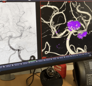 A computer monitor displays two medical brain scans; the left shows blood vessels in grayscale, while the right shows a 3D scan with white vessels and areas highlighted in purple. A webcam and a phone sit below the screen.