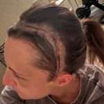 A person with brown hair has a large healing surgical scar on the side of their scalp. The scar is stitched and runs from above the ear toward the back of the head. They are sitting indoors, wearing a gray shirt.