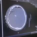 A computer screen displays a brain CT scan showing a large abnormal dark area on one side, possibly indicating trauma or a medical condition. The scan includes technical details and measurement markers.