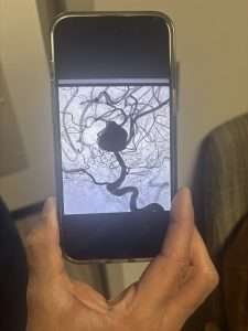 A hand holding a smartphone displaying a medical image of blood vessels, with a dark, balloon-like bulge in the center, suggesting an aneurysm.