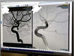 Two grayscale brain angiogram images are displayed side by side on a computer monitor, showing blood vessels in the brain. Patient information in the top corners is obscured for privacy.