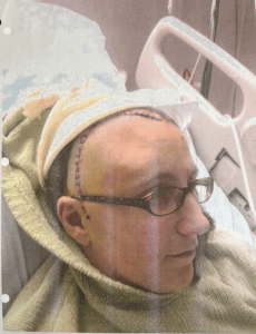 A person wearing glasses is lying in a hospital bed with a large stitched surgical scar on their shaved scalp, partially covered by a blanket and cap.