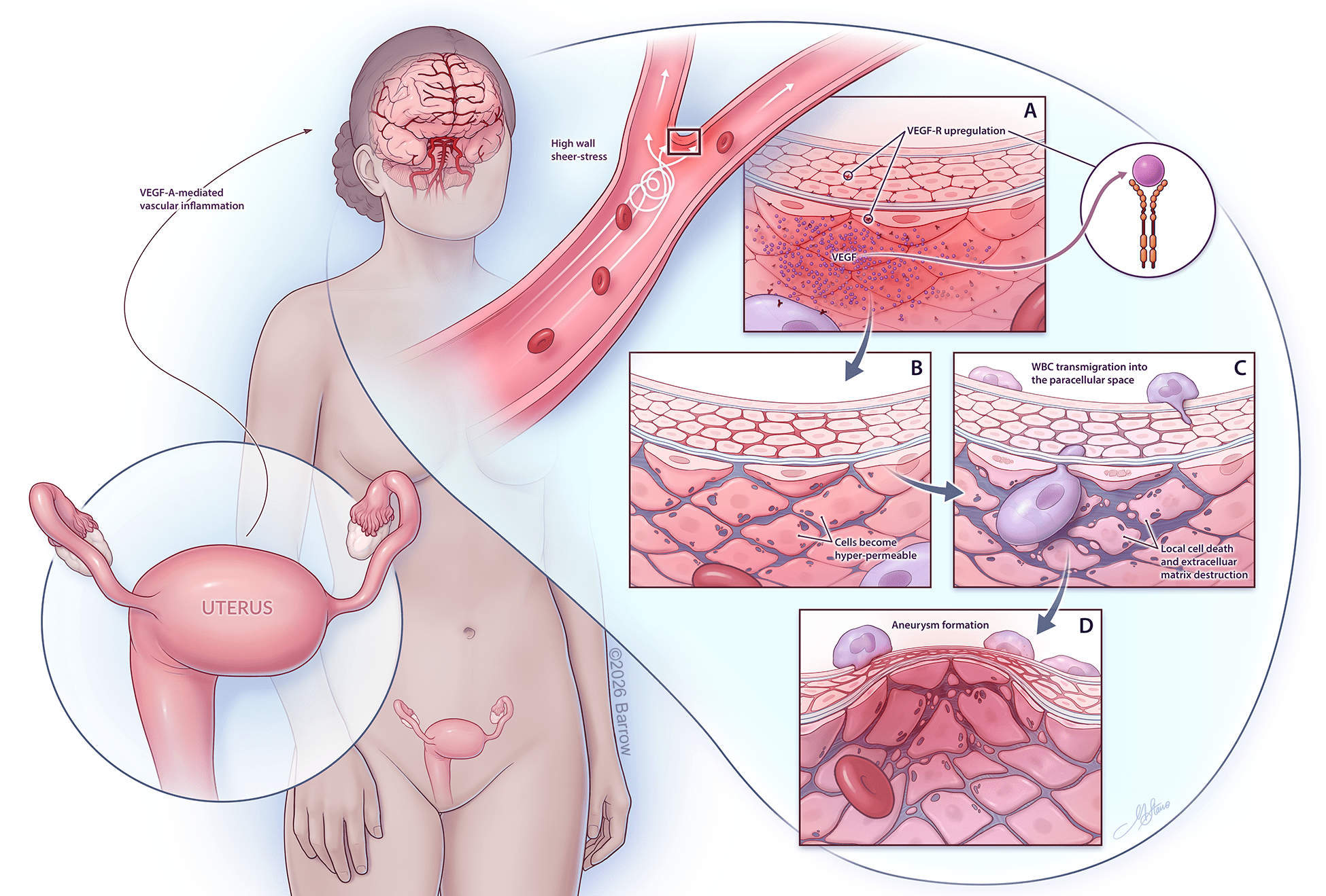 Medical illustration shows a female figure with highlighted uterus and brain blood vessels, and four panels detailing how VEGF-A upregulation and MMPs contribute to vessel changes, inflammation, and aneurysm formation in the brain.