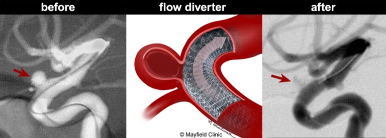 mayfield clinic brain aneurysm flow diverter